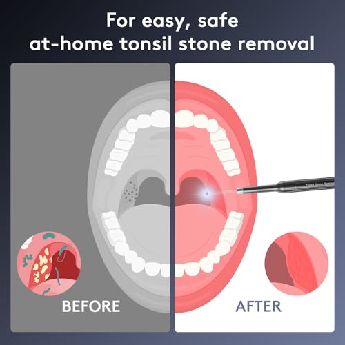 Tonsil Stone Removal Kit with Camera- 2025 Upgraded Tonsil Stone Remover Tool Connect with WIFI - Visual Led Light Tonsillolith Removal Tool with 4 Head Attachments (Black)