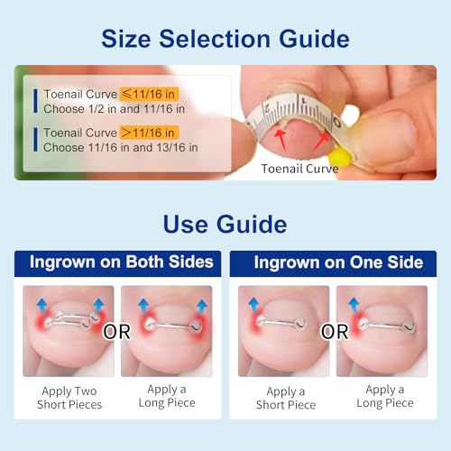 Nitinol Ingrown Toenail Corrector,at Home Ingrown Toenail Treatment,Curved Toenail Straightener,Ingrown Toe Nail Relief,Ingrown Toenail Removal Kit (11/16 In,13/16 In)