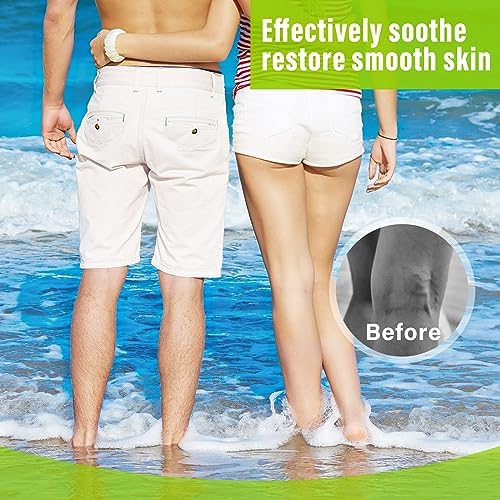 MOSKILA Varicose Veins Treatment for Legs, 2 Count Nature Varicose Veins Cream, Effective Varicose Veins Treatment for Varicose & Spider Veins, Relieve Leg Swelling & Fatigue Relief, 0.7oz