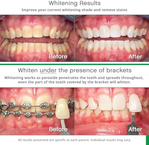 Opalescence Whitening Bundle - Opalescence Go 15% Hydrogen Peroxide Prefilled Whitening Trays and Whitening Toothpaste - Mint Flavor 5194-5166