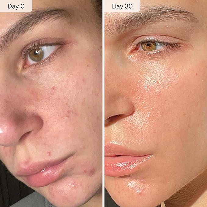 Qure Micro Infusion System for Face & Neck - Facial Moisturizing Essence, Even-looking tone, Serum for All Skin Types, Refreshed and Luminous Skin - 5-Month Supply