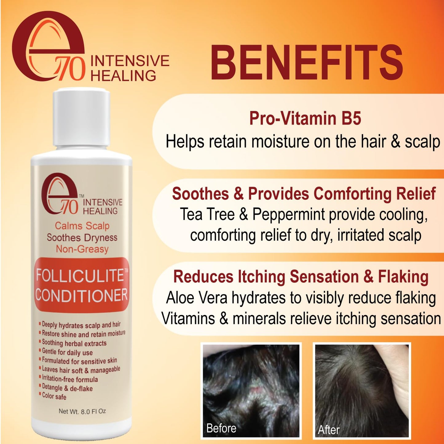 Folliculitis Treatment Conditioner with 3% BHA, Salicylic Acid, Tea Tree Oil & Chamomile Extracts - Anti Itch for women & men with Irritated Flaky Scalp Acne Treatment, Made in USA by e70, 8 fl oz